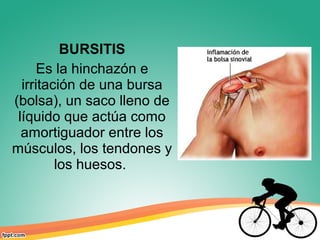 BURSITIS
Es la hinchazón e
irritación de una bursa
(bolsa), un saco lleno de
líquido que actúa como
amortiguador entre los
músculos, los tendones y
los huesos.
 
