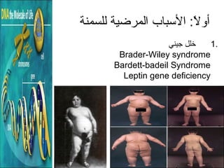 ‫للسمنة‬ ‫المرضية‬ ‫البسباب‬ : ‫ا‬‫ال‬ً:  ‫أو‬
1.‫جيني‬ ‫خلل‬
Brader-Wiley syndrome
Bardett-badeil Syndrome
Leptin gene deficiency
 