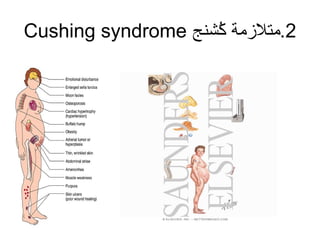 2‫كنشنج‬ُ‫ش‬ ‫.متلمزمة‬Cushing syndrome
 