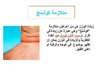 ‫ونشنج‬ُ‫ش‬ ‫ك‬ ‫متلمزمة‬‫ونشنج‬ُ‫ش‬ ‫ك‬ ‫متلمزمة‬
‫متلمزمة‬ ‫اعراض‬ ‫من‬ ‫هي‬ ‫الومزن‬ ‫مزيادة‬
‫في‬ ‫مزيادة‬ ‫عن‬ ‫عبارة‬ ‫وهي‬ “‫”كونشنغ‬
‫افرامز‬‫الكورتيزول‬ ‫هرمون‬‫الكورتيزول‬ ‫هرمون‬‫الغدة‬ ‫من‬
‫ان‬ ‫يمكن‬ ‫الومزن‬ ‫في‬ ‫الكظرية.والزيادة‬
‫او‬ ‫والرقبة‬ ‫الوجه‬ ‫في‬ ‫بوضوح‬ ‫تظهر‬
‫الظهر‬ ‫اعلى‬.
 