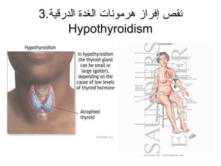 3.‫الدرقية‬ ‫الغدة‬ ‫هرمونات‬ ‫إفرامز‬ ‫نقص‬
Hypothyroidism
 