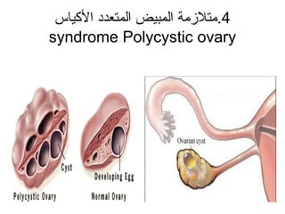 4‫الكياس‬ ‫المتعدد‬ ‫المبيض‬ ‫.متلمزمة‬
syndrome Polycystic ovary
 