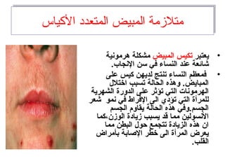 ‫الكياس‬ ‫المتعدد‬ ‫المبيض‬ ‫متلمزمة‬‫الكياس‬ ‫المتعدد‬ ‫المبيض‬ ‫متلمزمة‬
•‫يعتبر‬‫المبيض‬ ‫تكيس‬‫هرمونية‬ ‫مشكلة‬
.‫النجاب‬ ‫سن‬ ‫في‬ ‫النساء‬ ‫عند‬ ‫نشائعة‬
•‫على‬ ‫كيس‬ ‫لديهن‬ ‫تنتج‬ ‫النساء‬ ‫فمعظم‬
‫اختلل‬ ‫تسبب‬ ‫الحالة‬ ‫وهذه‬ .‫المبايض‬
‫الشهرية‬ ‫الدورة‬ ‫على‬ ‫تؤثر‬ ‫التي‬ ‫الهرمونات‬
‫نشعر‬ ‫نمو‬ ‫في‬ ‫الفراط‬ ‫الى‬ ‫تؤدي‬ ‫التي‬ ‫للمرأة‬
‫الجسم‬ ‫يقاوم‬ ‫الحالة‬ ‫هذه‬ ‫الجسم.وفي‬
‫الومزن،كما‬ ‫مزيادة‬ ‫يسبب‬ ‫قد‬ ‫مما‬ ‫النسولين‬
‫مما‬ ‫البطن‬ ‫حول‬ ‫تتجمع‬ ‫الزيادة‬ ‫هذه‬ ‫ان‬
‫بأمراض‬ ‫الاصابة‬ ‫خطر‬ ‫الى‬ ‫المرأة‬ ‫يعرض‬
.‫القلب‬
 