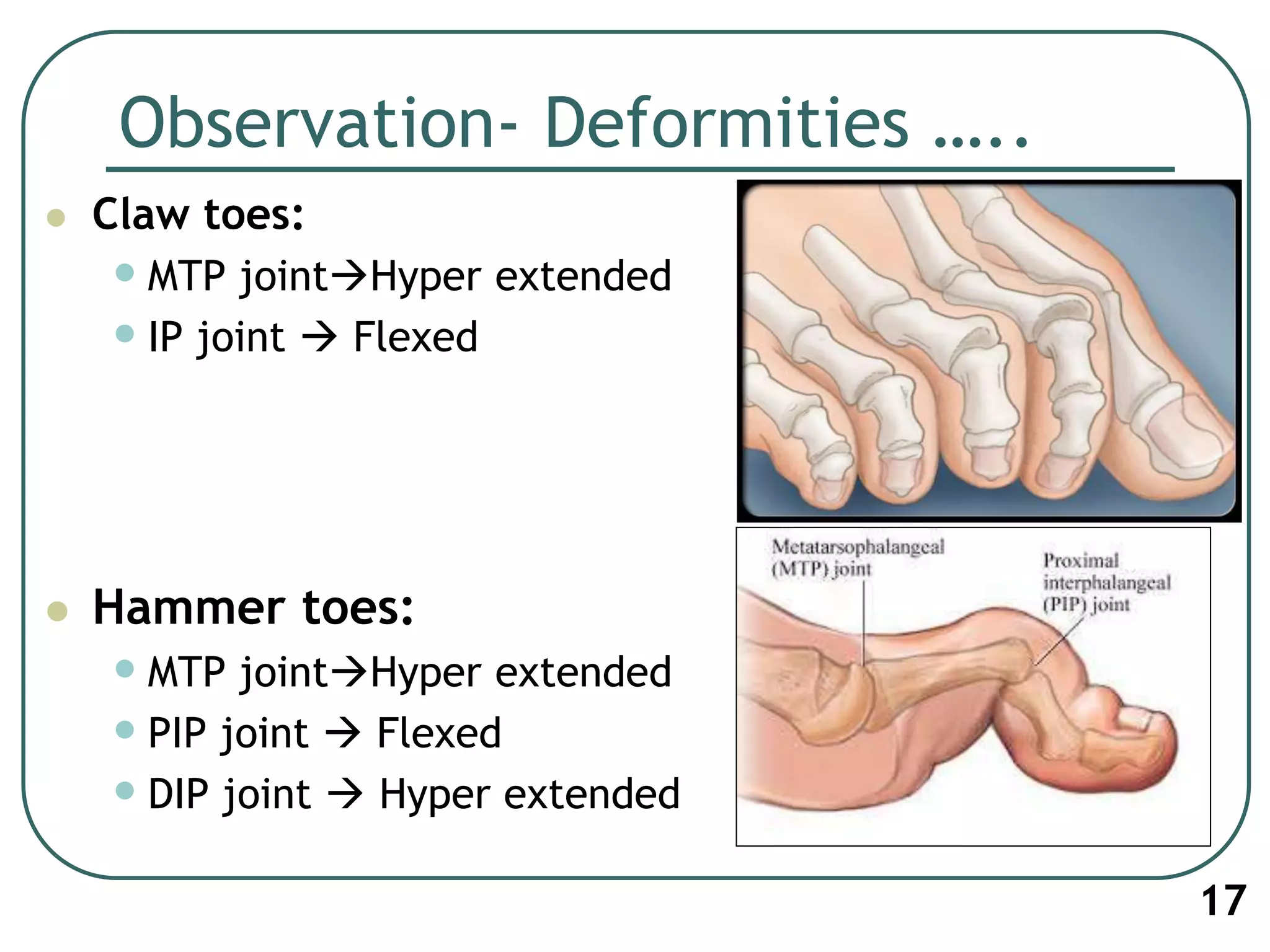 Observation- Deformities …..
 Claw toes:
•MTP jointHyper extended
•IP joint  Flexed
 Hammer toes:
•MTP jointHyper extended
•PIP joint  Flexed
•DIP joint  Hyper extended
17
 
