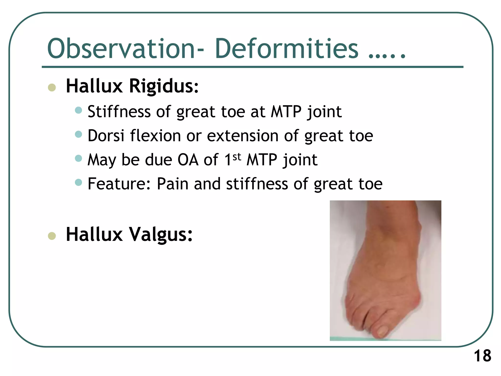 Observation- Deformities …..
 Hallux Rigidus:
•Stiffness of great toe at MTP joint
•Dorsi flexion or extension of great toe
•May be due OA of 1st MTP joint
•Feature: Pain and stiffness of great toe
 Hallux Valgus:
18
 