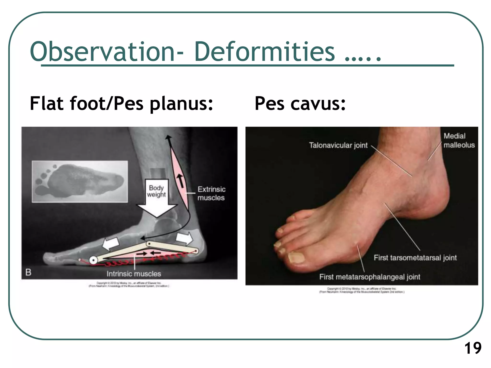 Observation- Deformities …..
Flat foot/Pes planus: Pes cavus:
19
 