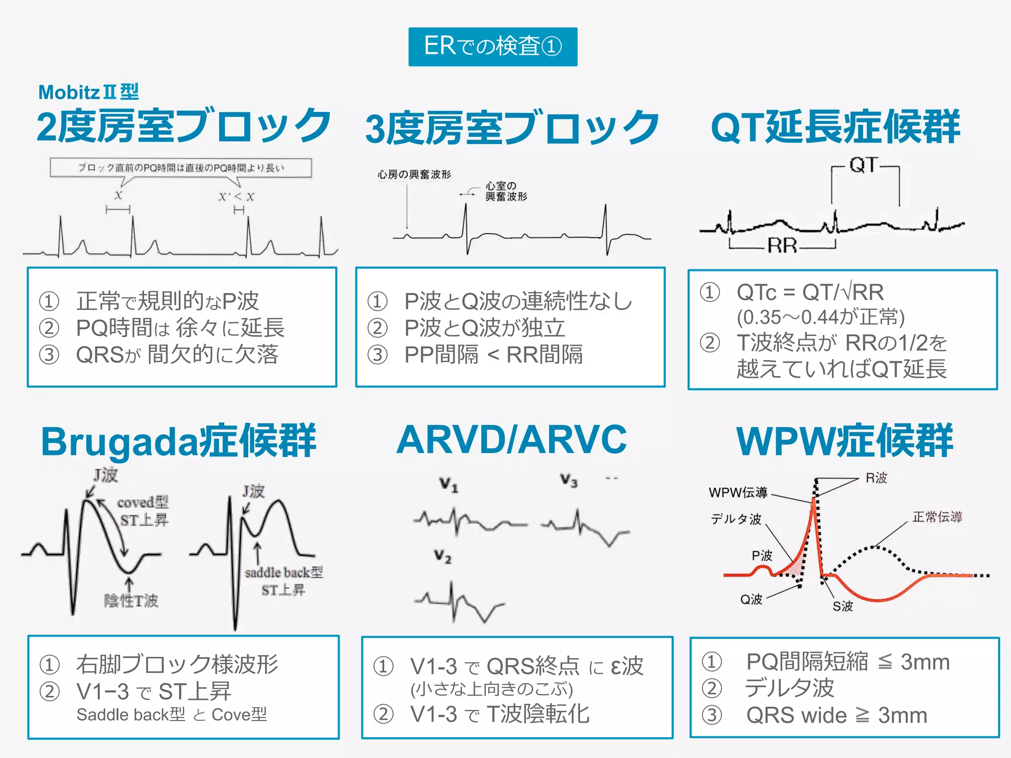 ERでの検査①
WPW症候群Brugada症候群
①  PQ間隔短縮 ≦ 3mm
②  デルタ波
③  QRS wide ≧ 3mm
①  右脚ブロック様波形
②  V1−3 で ST上昇
Saddle back型 と Cove型
QT延⻑症候群
①  QTc = QT/√RR
(0.35〜0.44が正常)
②  T波終点が RRの1/2を
越えていればQT延⻑
ARVD/ARVC
①  V1-3 で QRS終点 に ε波
(⼩さな上向きのこぶ)
②  V1-3 で T波陰転化
3度房室ブロック
①  P波とQ波の連続性なし
②  P波とQ波が独⽴
③  PP間隔 < RR間隔
①  正常で規則的なP波
②  PQ時間は 徐々に延⻑
③  QRSが 間⽋的に⽋落
2度房室ブロック
MobitzⅡ型
 
