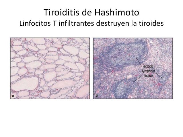 Reacciones de hipersensibilidad