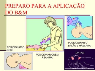 PREPARO PARA A APLICAÇÃO
DO B&M
POSICIONAR O
BEBÊ
POSICIONAR QUEM
REANIMA
POSIOCIONAR O
BALÃO E MÁSCARA
EVITAR
 