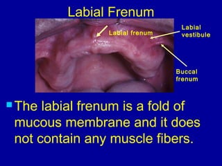 Labial frenum
Labial
vestibule
Buccal
frenum
Labial Frenum
 The labial frenum is a fold of
mucous membrane and it does
not contain any muscle fibers.
 