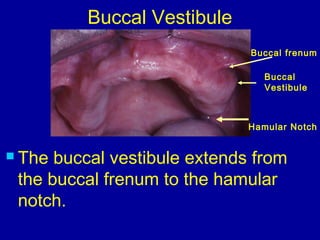 Hamular Notch
Buccal
Vestibule
Buccal Vestibule
 The buccal vestibule extends from
the buccal frenum to the hamular
notch.
Buccal frenum
 