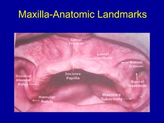Maxilla-Anatomic Landmarks
 