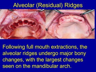 Alveolar (Residual) Ridges
Following full mouth extractions, the
alveolar ridges undergo major bony
changes, with the largest changes
seen on the mandibular arch.
 