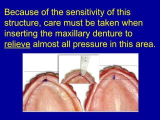 Because of the sensitivity of this
structure, care must be taken when
inserting the maxillary denture to
relieve almost all pressure in this area.
 