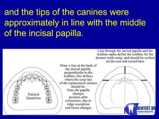 and the tips of the canines were
approximately in line with the middle
of the incisal papilla.
 