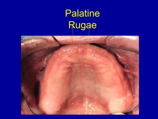 Palatine
Rugae
 