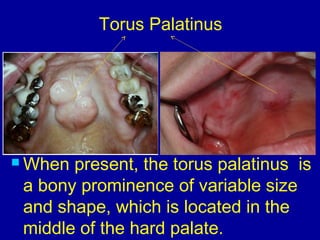 Torus Palatinus
 When present, the torus palatinus is
a bony prominence of variable size
and shape, which is located in the
middle of the hard palate.
 