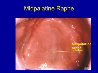 Midpalatine Raphe
Midpalatine
raphe
 