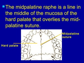  The midpalatine raphe is a line in
the middle of the mucosa of the
hard palate that overlies the mid-
palatine suture.
Midpalatine
suture
Hard palate
 