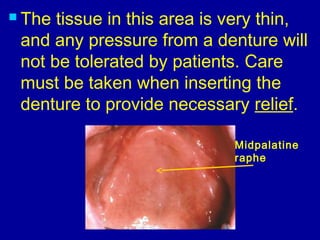 The tissue in this area is very thin,
and any pressure from a denture will
not be tolerated by patients. Care
must be taken when inserting the
denture to provide necessary relief.
Midpalatine
raphe
 