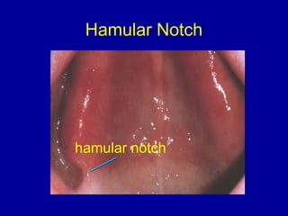 Hamular Notch
hamular notch
 
