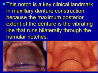  This notch is a key clinical landmark
in maxillary denture construction
because the maximum posterior
extent of the denture is the vibrating
line that runs bilaterally through the
hamular notches.
 
