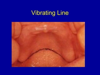 Vibrating Line
 