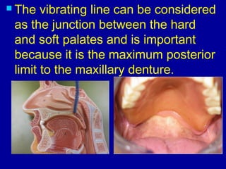  The vibrating line can be considered
as the junction between the hard
and soft palates and is important
because it is the maximum posterior
limit to the maxillary denture.
 
