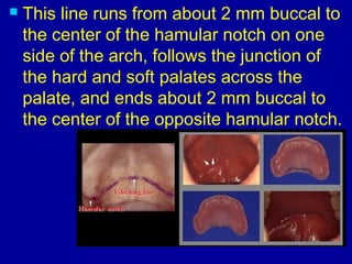  This line runs from about 2 mm buccal to
the center of the hamular notch on one
side of the arch, follows the junction of
the hard and soft palates across the
palate, and ends about 2 mm buccal to
the center of the opposite hamular notch.
 
