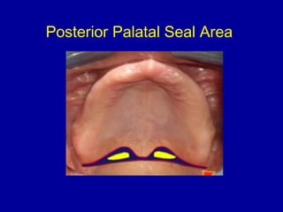 Posterior Palatal Seal Area
 