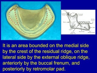It is an area bounded on the medial side
by the crest of the residual ridge, on the
lateral side by the external oblique ridge,
anteriorly by the buccal frenum, and
posteriorly by retromolar pad.
 