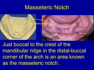 Just buccal to the crest of the
mandibular ridge in the distal-buccal
corner of the arch is an area known
as the masseteric notch.
Masseteric Notch
Masseteric Notch
 