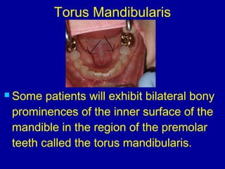  Some patients will exhibit bilateral bony
prominences of the inner surface of the
mandible in the region of the premolar
teeth called the torus mandibularis.
Torus Mandibularis
 