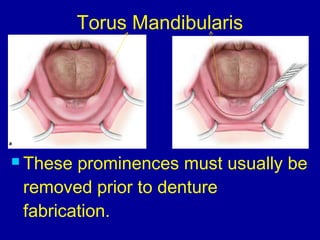  These prominences must usually be
removed prior to denture
fabrication.
Torus Mandibularis
 