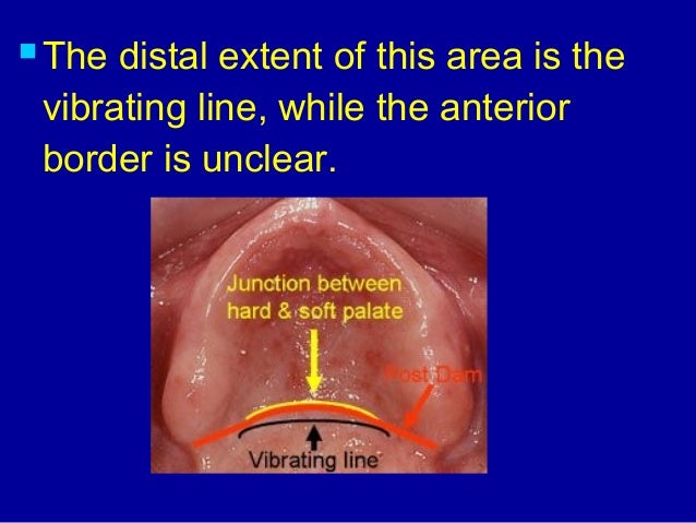 posterior palatal seal
