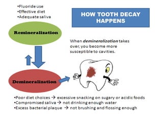 HOW TOOTH DECAY
HAPPENS
 