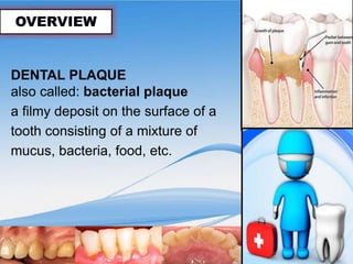 DENTAL PLAQUE
also called: bacterial plaque
a filmy deposit on the surface of a
tooth consisting of a mixture of
mucus, bacteria, food, etc.
OVERVIEW
 