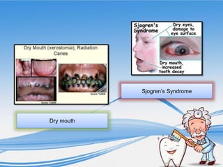 Dry mouth
Sjogren’s Syndrome
 
