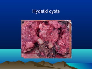 Hydatid cystsHydatid cysts
 