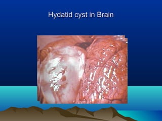 Hydatid cyst in BrainHydatid cyst in Brain
 