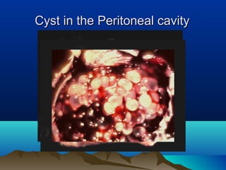Cyst in the Peritoneal cavityCyst in the Peritoneal cavity
 