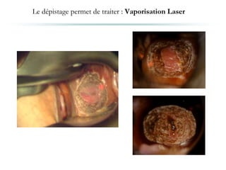 Le dépistage permet de traiter : Vaporisation Laser
 