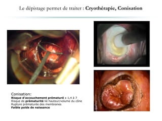 Le dépistage permet de traiter : Cryothérapie, Conisation
Conisation:
Risque d’accouchement prématuré x 1,4 à 7
Risque de prématurité lié hauteur/volume du cône
Rupture prématurée des membranes
Faible poids de naissance
 