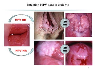 Infection HPV dans la vraie vie
8
HPV BR
HPV HR
20
ans
30
ans
 