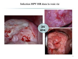 Infection HPV HR dans la vraie vie
9
35
ans
 