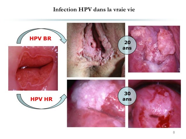 Genital Warts Photos - Dermatology Education