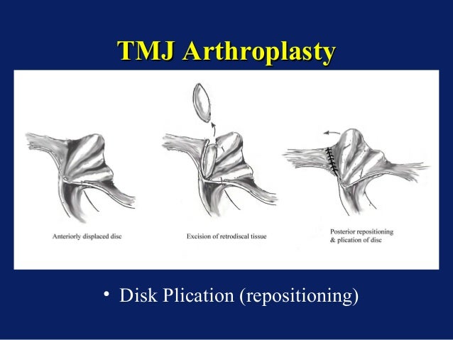 overview tmj surgery / dental courses