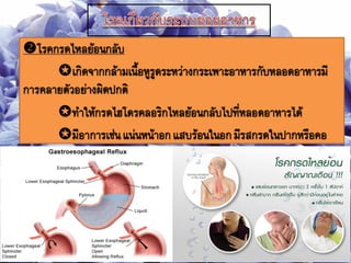 โรคกรดไหลย้อนกลับ
เกิดจากกล้ามเนือหูรูดระหว่างกระเพาะอาหารกับหลอดอาหารมี
การคลายตัวอย่างผิดปกติ
ทาให้กรดไฮโดรคลอริกไหลย้อนกลับไปที่หลอดอาหารได้
มีอาการเช่นแน่นหน้าอกแสบร้อนในอกมีรสกรดในปากหรือคอ
 