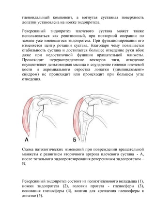 гленоидальный компонент, а вогнутая суставная поверхность
лопатки установлена на ножке эндопротеза.
Реверсивный эндопротез плечевого сустава может также
использоваться как ревизионный, при повторной операции по
замене уже имеющегося эндопротеза. При функционировании его
изменяется центр ротации сустава, благодаря чему повышается
стабильность сустава и достигается большее отведение руки вбок
даже при недостаточной функции вращательной манжеты.
Происходит перераспределение векторов тяги, отведение
осуществляет дельтовидная мышца и соударение головки плечевой
кости и акромиального отростка лопатки («импинджмент»
синдром) не происходит или происходит при большем угле
отведения.
Схема патологических изменений при повреждении вращательной
манжеты с развитием вторичного артроза плечевого сустава - А,
после тотального эндопротезирования реверсивным эндопротезом –
В.
Реверсивный эндопротез состоит из полиэтиленового вкладыша (1),
ножки эндопротеза (2), головки протеза - гленосферы (3),
основания гленосферы (4), винтов для крепления гленосферы к
лопатке (5).
 