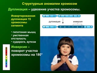 Дупликация – удвоение участка хромосомы.
Структурные аномалии хромосом
Инвертированная
дупликация 15
хромосомы
сегмента
• гипотония мышц
• умственная
отсталость
• судороги, аутизм
дупликация инверсия
Инверсия –
поворот участка
хромосомы на 180°
 